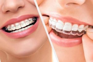 invisalign services