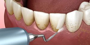 teeth cleaning services