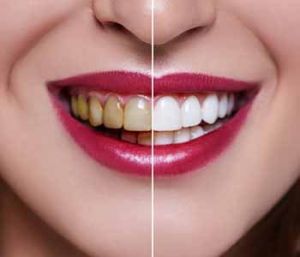 Teeth Whitening Services