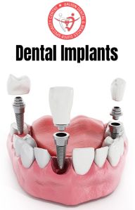 Dental Implants