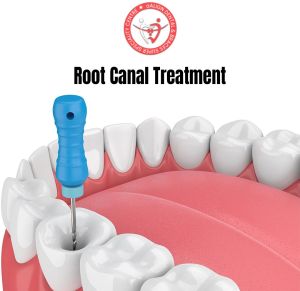 Root Canal Treatment