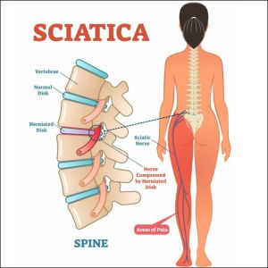 Sciatica Pain Healing Services