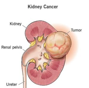 kidney cancer treatment services