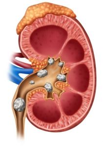 kidney stone treatment service