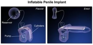 penile implants treatment services