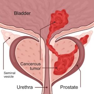 Prostate Cancer Treatment Services