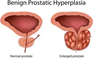 prostate enlargement treatment service