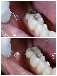single sitting root canal treatment