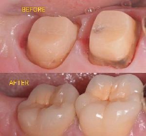 Dental Implant