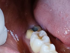 Dental Inlays and Onlays