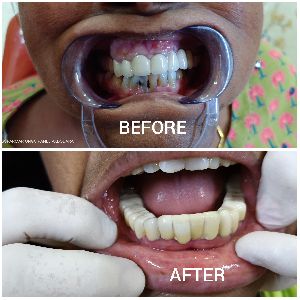 Dental Restoration