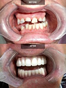 all in 6 dental implants