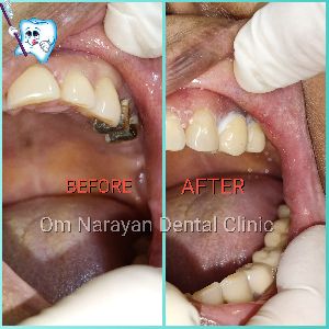 one day dental implants