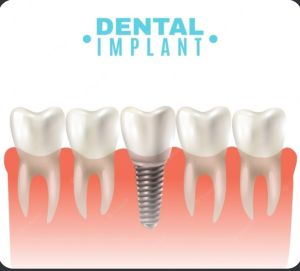 Collagen Bone Graft