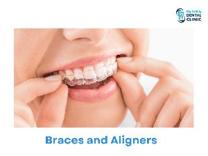 Braces and Aligners