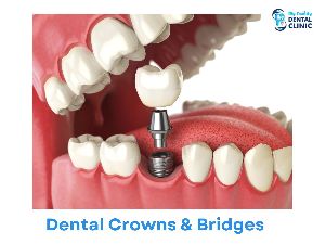 Dental Crowns & Bridges