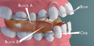 Twin Block Appliance Treatment