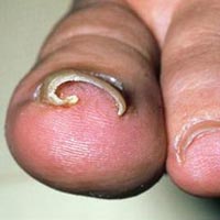 INGROWN TOE NAIL SURGERY