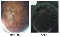 Hair Regrowth Treatment Clinic in Bangalore