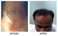 PRP for Hair Loss in Bangalore, Platelet Rich Plasma for Hair Loss