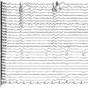 Electroencephalograph Paper (EEG Paper)