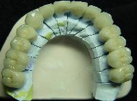 Dental Ceramic Laminations