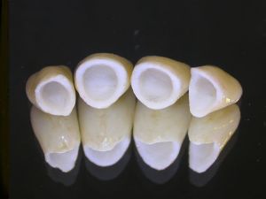 Dental Crowns