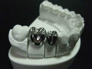 Metal Ceramic Crowns