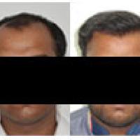 Best Hair Transplant  Center