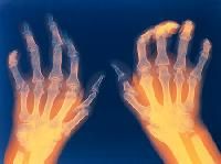 rheumatoid arthritis