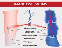 Endovenous Laser Ablation