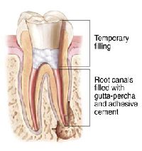 Root Canal Sealing