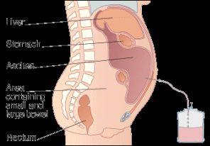 Ascites Treatment