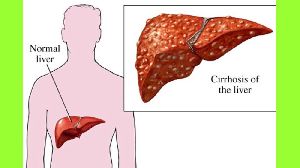 Liver Cirrhosis Treatment