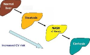 Nonalcoholic steatohepatitis Treatment