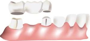 dental bridge