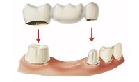 Dental Crowns