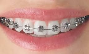 dental brace