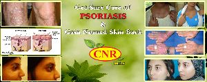 C N Rajadurai Psoriasis Treatment chennai Tamilnadu