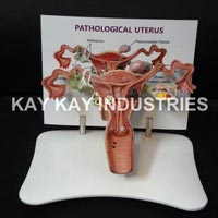 Pathological Uterus Model