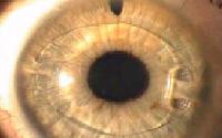 Intraocular Lenses