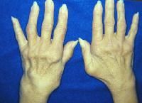 rheumatoid arthritis