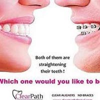 Clear Path Aligners Invisible Braces