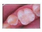 Cosmetic Tooth Colored Fillings