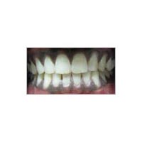 Laser Gums De Pigmentation