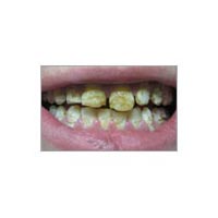 Mottling of Teeth Correction