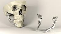 medical implants