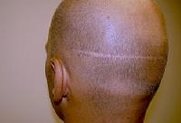 FUT hair transplant treatment