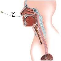 Gastric Tube