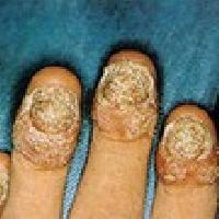 Nail Psoriasis Treatment